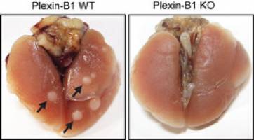 Neuer Antik�rper unterdr�ckt Bildung von Brustkrebs-Metastasen