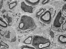 Gliazellen helfen bei der Reparatur verletzter Nerven