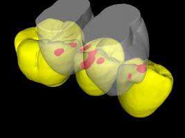 Materialverlust sch�tzt Z�hne gegen Erm�dungsbruch