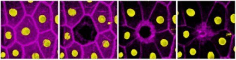 Diabetes: Neue Hoffnung für verbesserte Wundheilung