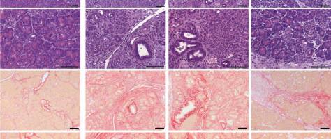 A disease trigger for pancreatitis has been identified