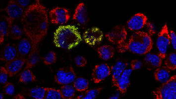 Neu entdeckter Gendefekt verursacht neurodegenerative Erkrankung mit breitem Symptomspektrum