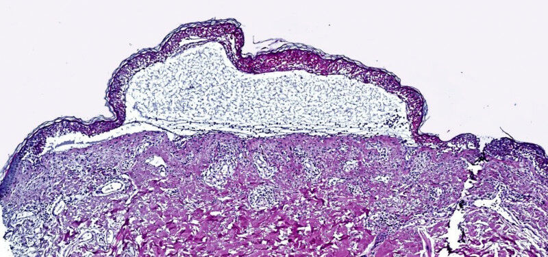 Epidermal detachment by toxic Epidermal Necrolysis. © T. Nordmann