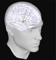 Neue elektrische Signatur f�r Parkinson
