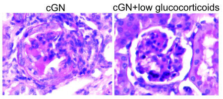 Weniger kann mehr sein: Niedrig dosierte Steroide bei Nierenentz�ndungen