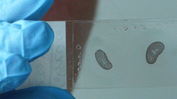 Learning from rare diseases to treat common ailments