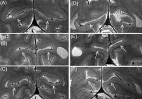 Auch Blinde besitzen Gennari-Streifen im Gehirn