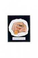 Ausstellung: ,,Krankheit als Kunst(form) - Moulagen der Medizin