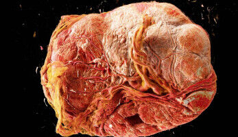 Gesundheit - Die Diagnostik in eine neue Dimension bringen - UNI-GOETTINGEN Die Diagnostik in eine neue Dimension bringen