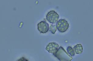 Essensreste im Zahnstein