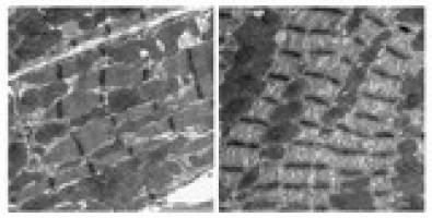 Hilfe bei Herzschw�che nach Chemotherapie