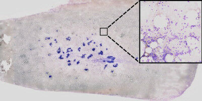 Leukämie: Künstliche Intelligenz unterstützt bei der Diagnostik