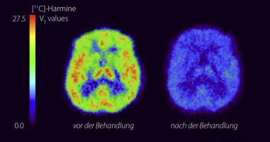 Monoaminoxidase-A: Biomarker für Wochenbett-Depression