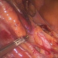 New Research Training Group for cancer surgery