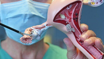 Vorsorgliche Eileiterentfernung kann Krebsf�lle und Gesundheitskosten deutlich reduzieren